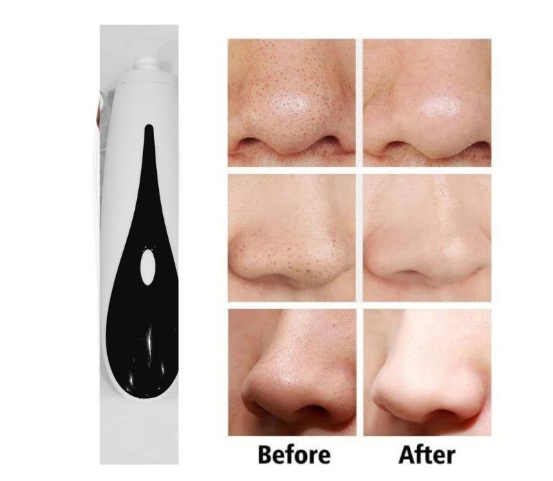 5 in 1 Blackhead  Remover