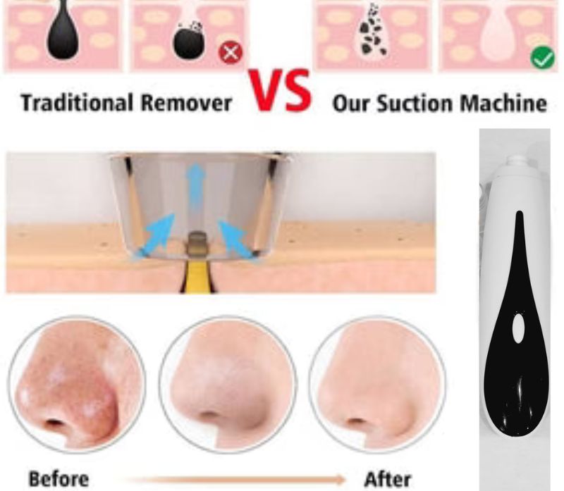 5 in 1 Blackhead  Remover